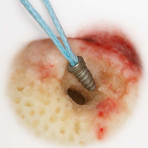 Bone anchor pullout failure